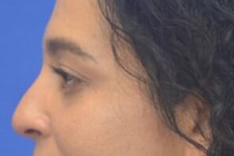 Blepharoplasty Before & After Gallery - Patient 408268 - Image 6