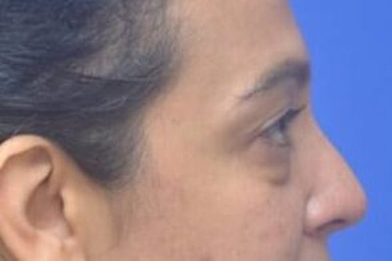 Blepharoplasty Before & After Gallery - Patient 408268 - Image 7
