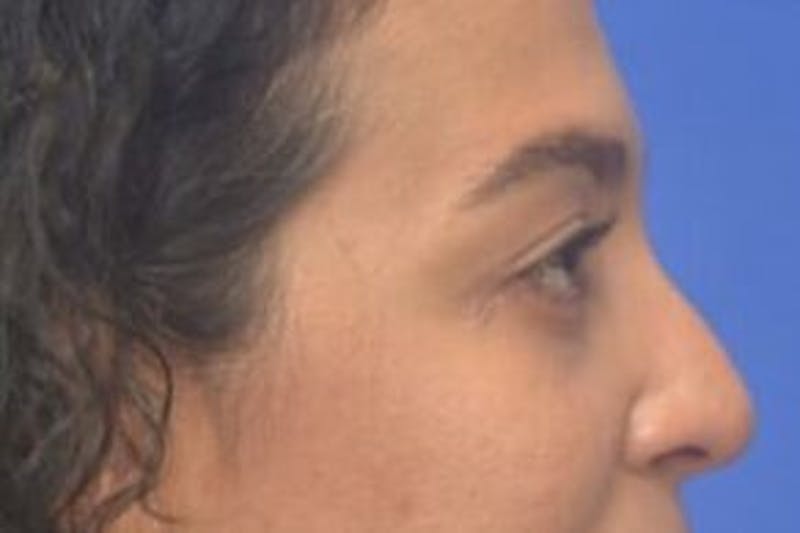 Blepharoplasty Before & After Gallery - Patient 408268 - Image 8