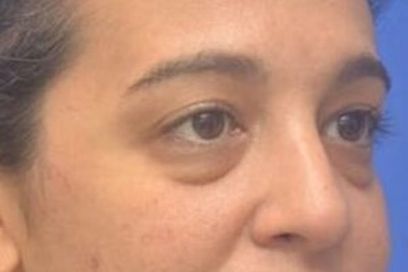 Blepharoplasty Before & After Gallery - Patient 408268 - Image 9