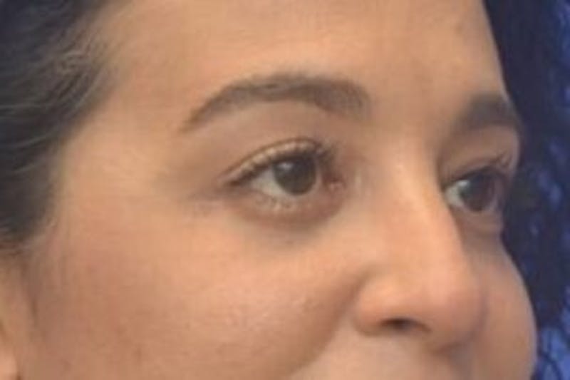 Blepharoplasty Before & After Gallery - Patient 408268 - Image 10