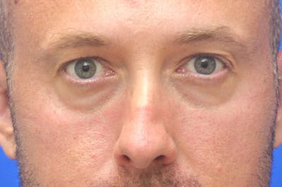 Blepharoplasty Before & After Gallery - Patient 268638 - Image 1