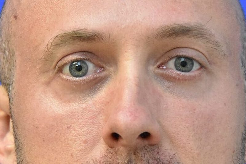 Blepharoplasty Before & After Gallery - Patient 268638 - Image 2