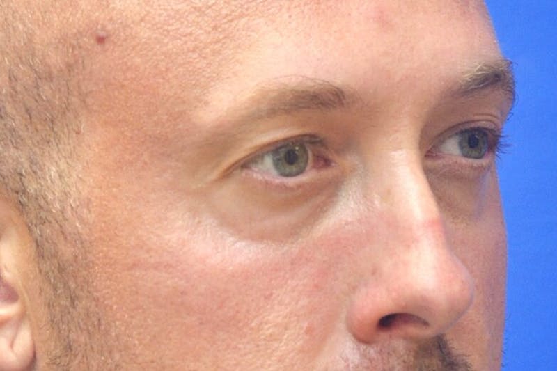 Blepharoplasty Before & After Gallery - Patient 268638 - Image 3
