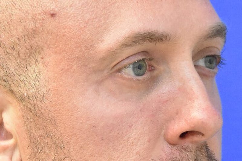 Blepharoplasty Before & After Gallery - Patient 268638 - Image 4