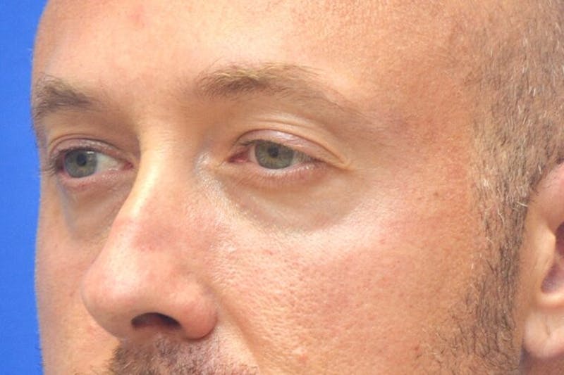 Blepharoplasty Before & After Gallery - Patient 268638 - Image 5