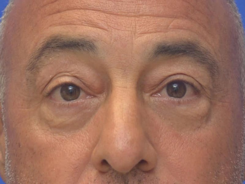Blepharoplasty Before & After Gallery - Patient 173446 - Image 1