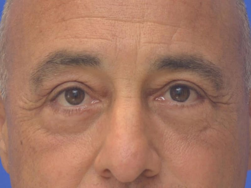 Blepharoplasty Before & After Gallery - Patient 173446 - Image 2
