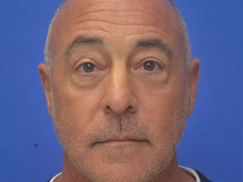 Blepharoplasty Before & After Gallery - Patient 173446 - Image 3