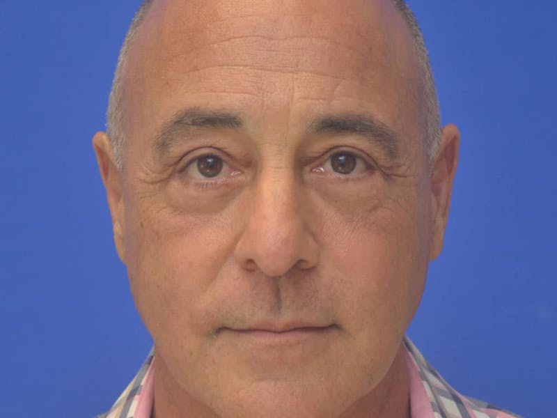 Blepharoplasty Before & After Gallery - Patient 173446 - Image 4