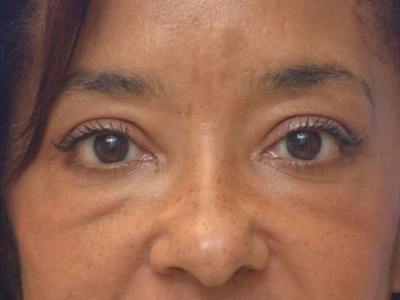 Blepharoplasty Before & After Gallery - Patient 641214 - Image 1