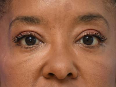 Blepharoplasty Before & After Gallery - Patient 641214 - Image 2