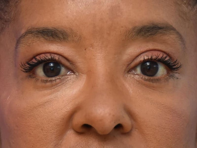 Blepharoplasty Before & After Gallery - Patient 641214 - Image 2