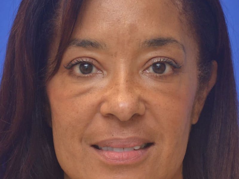 Blepharoplasty Before & After Gallery - Patient 641214 - Image 3