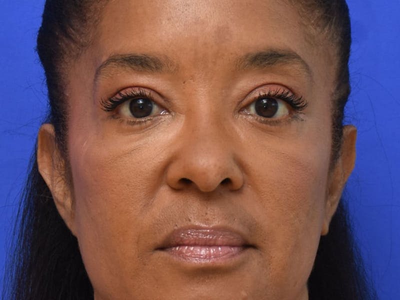 Blepharoplasty Before & After Gallery - Patient 641214 - Image 4