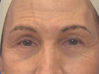 Blepharoplasty Before & After Gallery - Patient 175584 - Image 1