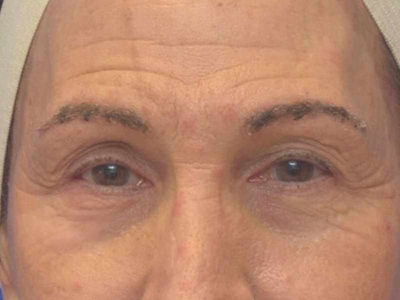 Blepharoplasty Before & After Gallery - Patient 175584 - Image 1
