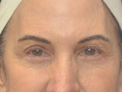 Blepharoplasty Before & After Gallery - Patient 175584 - Image 2