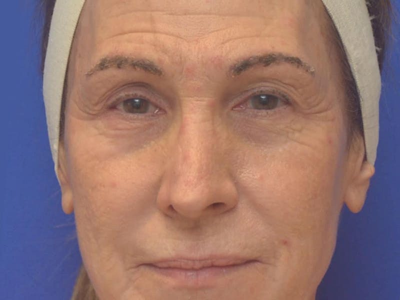 Blepharoplasty Before & After Gallery - Patient 175584 - Image 3