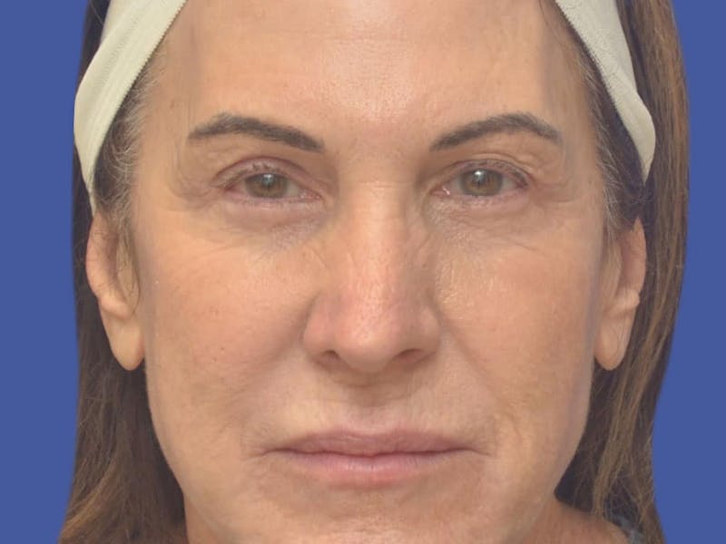 Blepharoplasty Before & After Gallery - Patient 175584 - Image 4