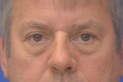 Blepharoplasty Before & After Gallery - Patient 329109 - Image 1