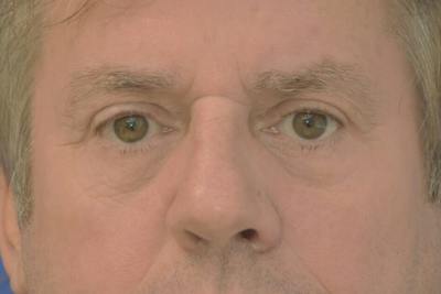 Blepharoplasty Before & After Gallery - Patient 329109 - Image 2