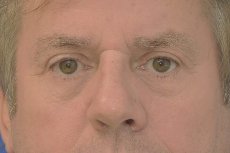 Blepharoplasty Before & After Gallery - Patient 329109 - Image 2