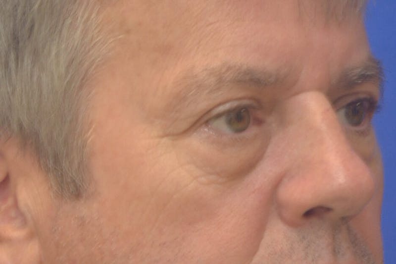 Blepharoplasty Before & After Gallery - Patient 329109 - Image 3