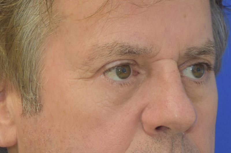 Blepharoplasty Before & After Gallery - Patient 329109 - Image 4