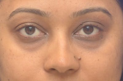 Blepharoplasty Before & After Gallery - Patient 113897 - Image 1