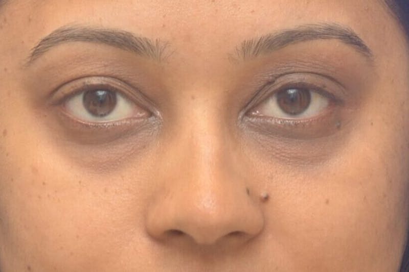 Blepharoplasty Before & After Gallery - Patient 113897 - Image 1