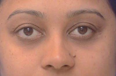 Blepharoplasty Before & After Gallery - Patient 113897 - Image 2