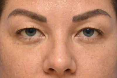 Blepharoplasty Before & After Gallery - Patient 216948 - Image 1