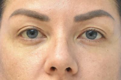 Blepharoplasty Before & After Gallery - Patient 216948 - Image 2