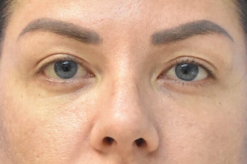 Blepharoplasty Before & After Gallery - Patient 216948 - Image 2