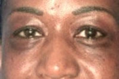 Blepharoplasty Before & After Gallery - Patient 695907 - Image 1