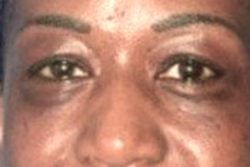 Blepharoplasty Before & After Gallery - Patient 695907 - Image 1