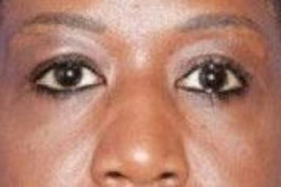 Blepharoplasty Before & After Gallery - Patient 695907 - Image 2