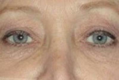 Blepharoplasty Before & After Gallery - Patient 427384 - Image 1