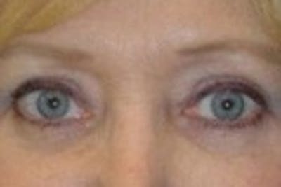 Blepharoplasty Before & After Gallery - Patient 427384 - Image 2