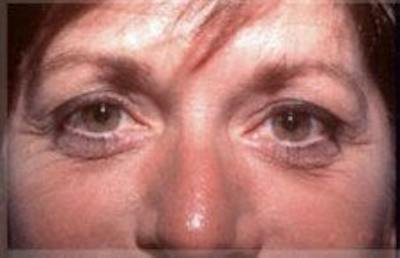 Blepharoplasty Before & After Gallery - Patient 392378 - Image 1