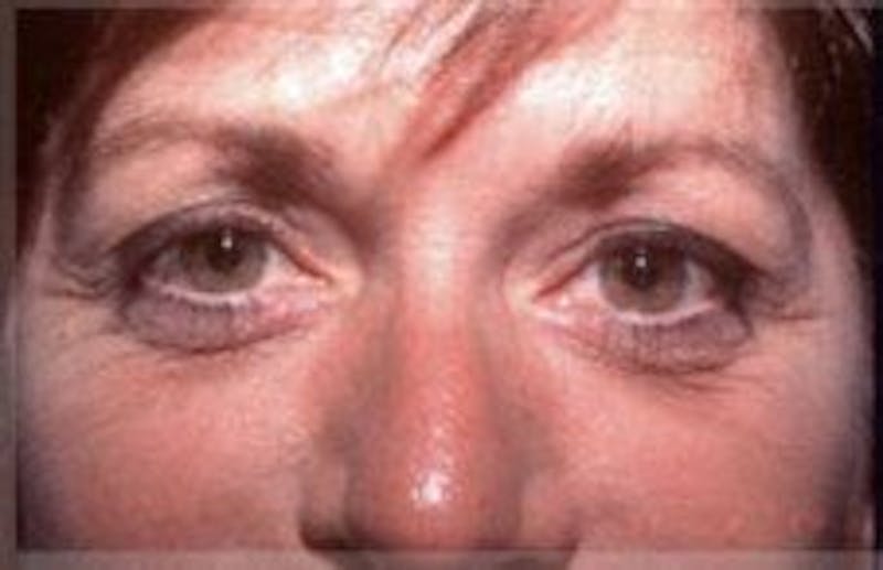 Blepharoplasty Before & After Gallery - Patient 392378 - Image 1