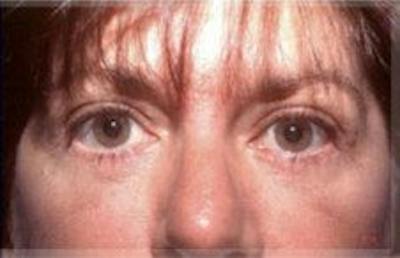 Blepharoplasty Before & After Gallery - Patient 392378 - Image 2