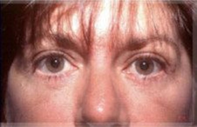 Blepharoplasty Before & After Gallery - Patient 392378 - Image 2