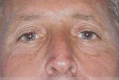 Blepharoplasty Before & After Gallery - Patient 134005 - Image 1