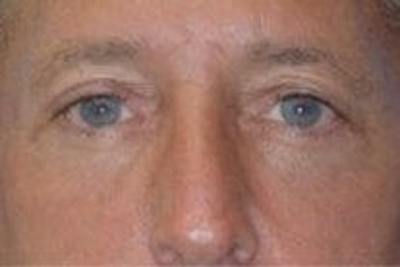 Blepharoplasty Before & After Gallery - Patient 134005 - Image 2