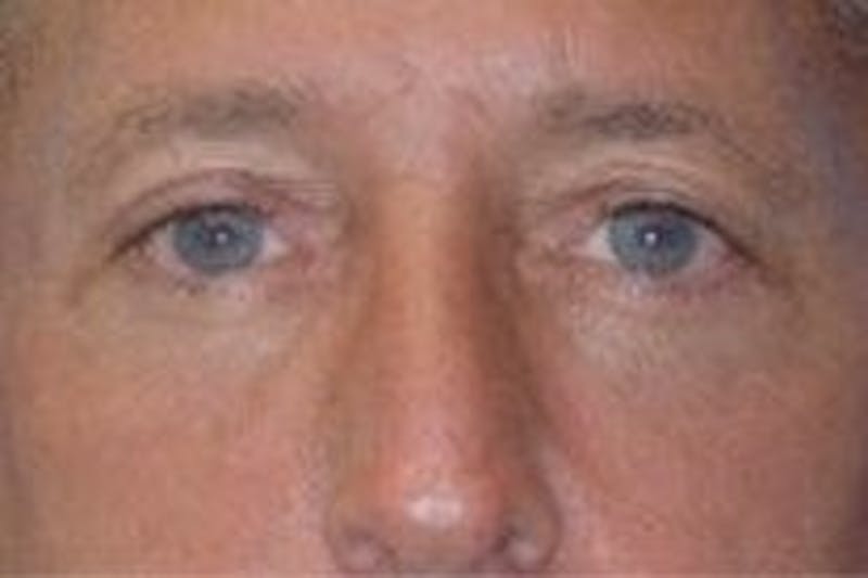 Blepharoplasty Before & After Gallery - Patient 134005 - Image 2