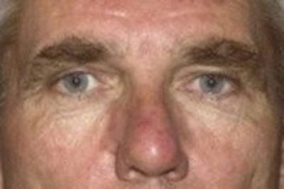 Blepharoplasty Before & After Gallery - Patient 354108 - Image 1