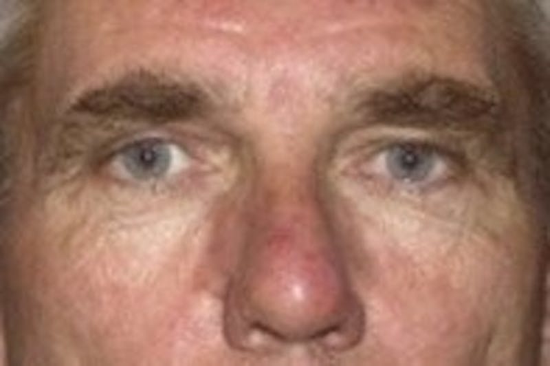 Blepharoplasty Before & After Gallery - Patient 354108 - Image 1