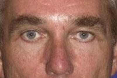 Blepharoplasty Before & After Gallery - Patient 354108 - Image 2